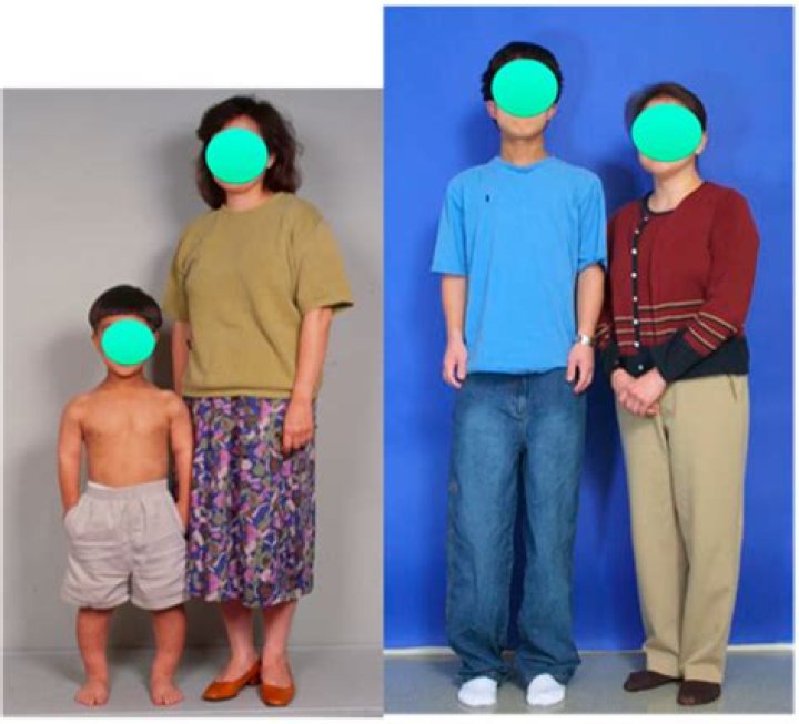 Achondroplasia MEDizzy