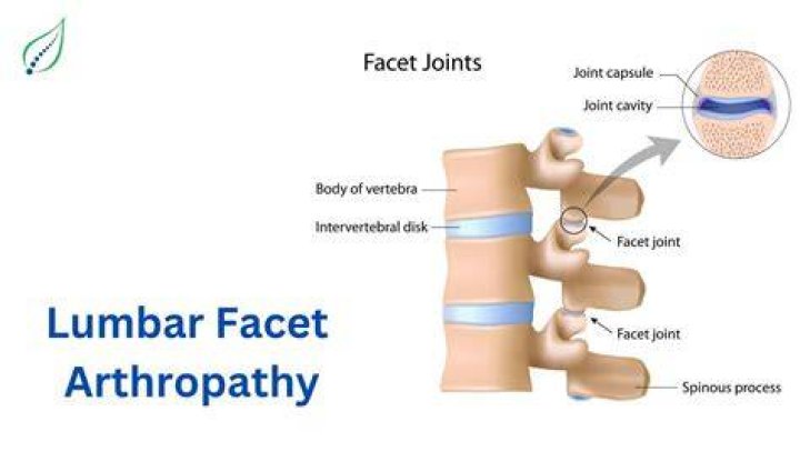 Arthropathy definition, facet arthropathy, lumbar facet arthropathy