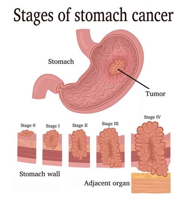 Can stomach cancer be treated successfully?