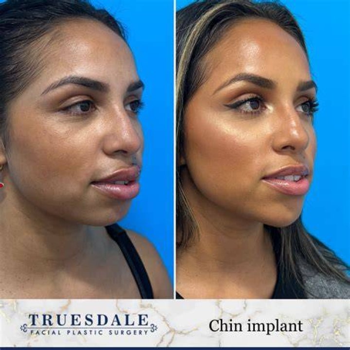 Carol Plastic Surgery (Chin Implants) See Transformation