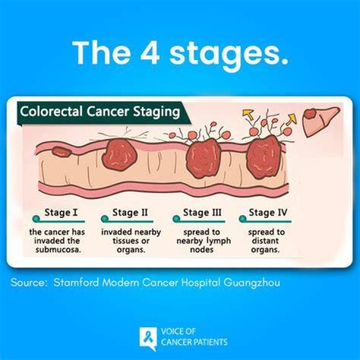 Colon Cancer Stage 4