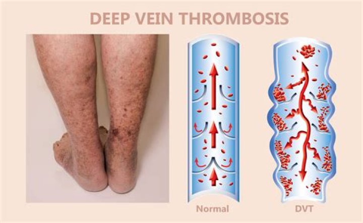 Deep Vein Thrombosis (DVT) BEVSA Buffalo Endovascular & Vascular