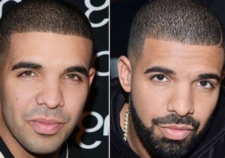 Did Drake Get a Nose Job Plastic Surgery?