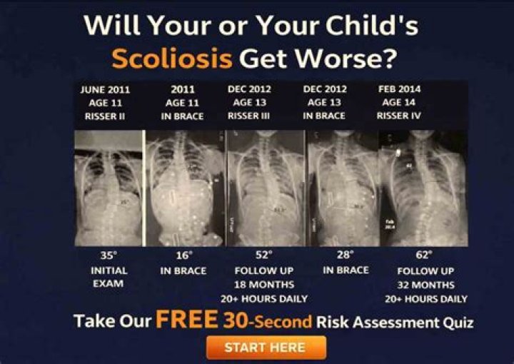 Does Scoliosis Get Worse Over Time? Scoliosis SOS