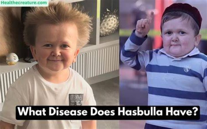 hasbulla disease Archives Newsone Nigeria