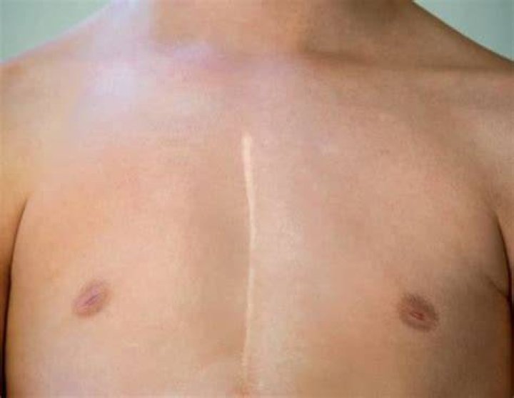 Heart Surgery Keloid Treatment Miami, FL