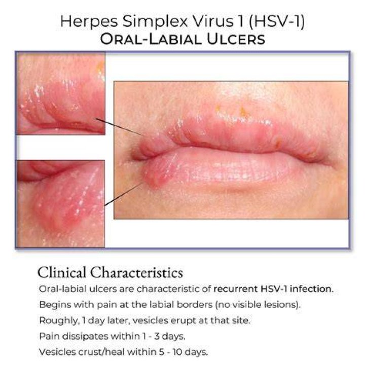 How do you permanently cure herpes simplex 1?