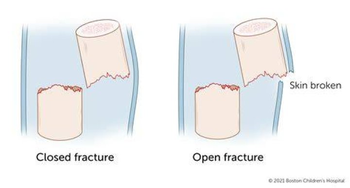 Is a closed fracture a clean break?