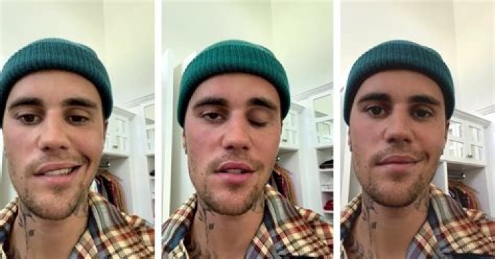 Justin Bieber suffering facial paralysis due to Ramsay Hunt syndrome