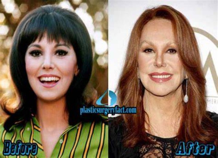 Marlo Thomas Plastic Surgery A Timeline Of Cosmetic Enhancements Rallshe