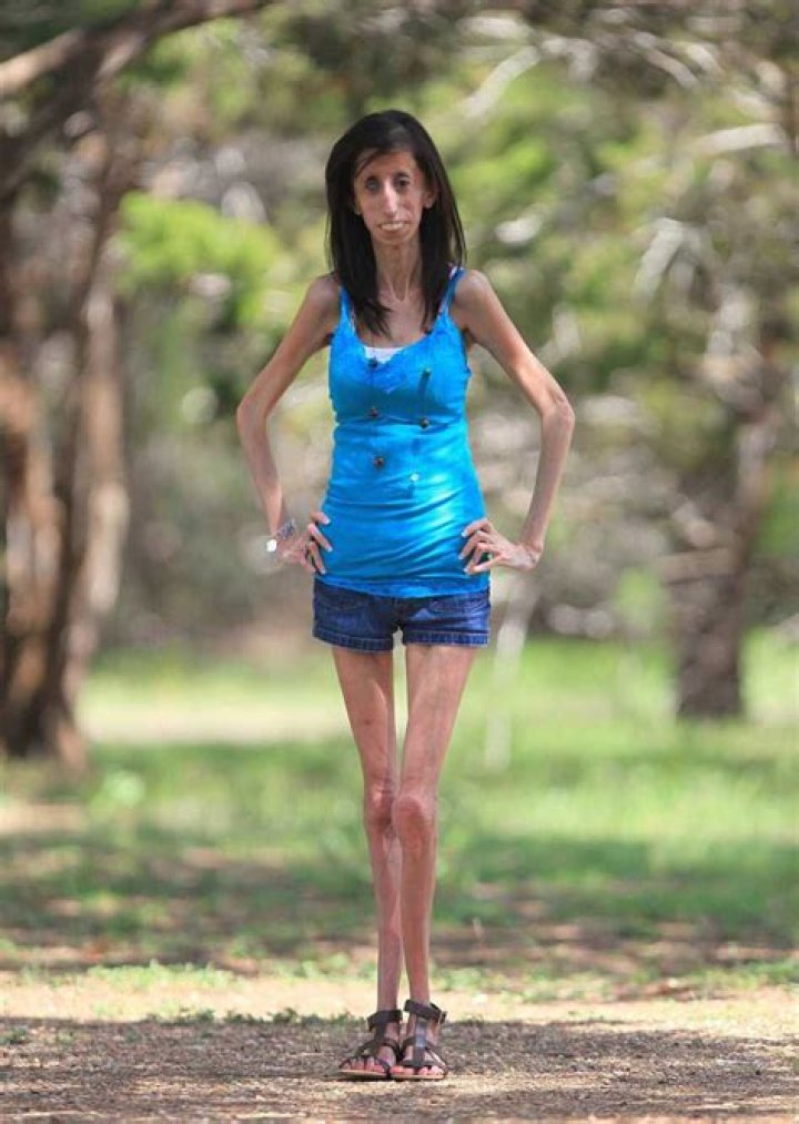 Meet The Remarkable 'World's Skinniest Lady'