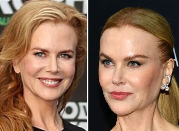 Nicole Kidman and her plastic surgery procedures