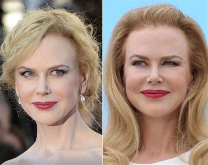 Nicole Kidman plastic surgery Celebrity Plastic Surgery celebrity