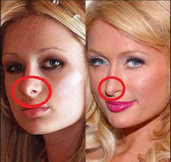 Paris Hilton Nose Job Plastic Surgery Before And After Rhinoplasty