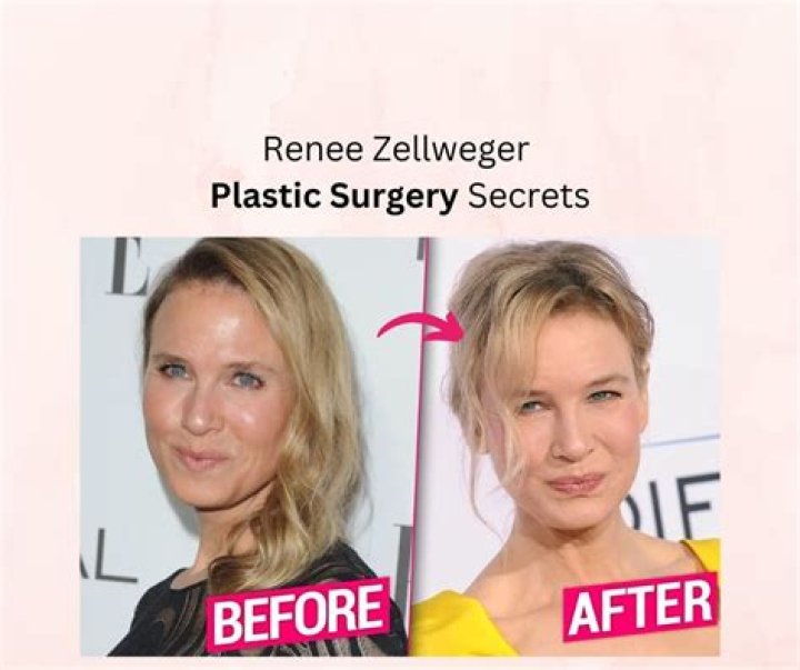 Renee Zellweger&rsquo;s Possible Plastic Surgery Makeover Revealed Claim Top Docs