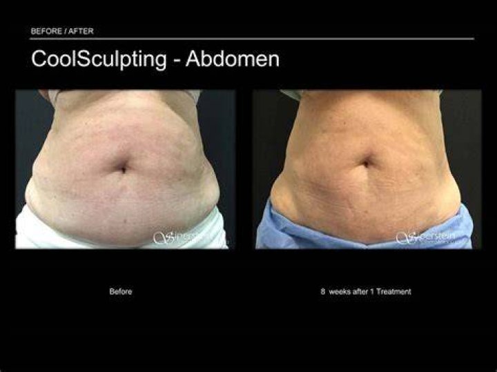 Should I Avoid CoolSculpting After Linda Evangelista's Reaction? Glowday