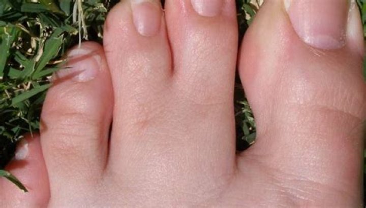 Webbed toes Causes, symptoms, and treatment
