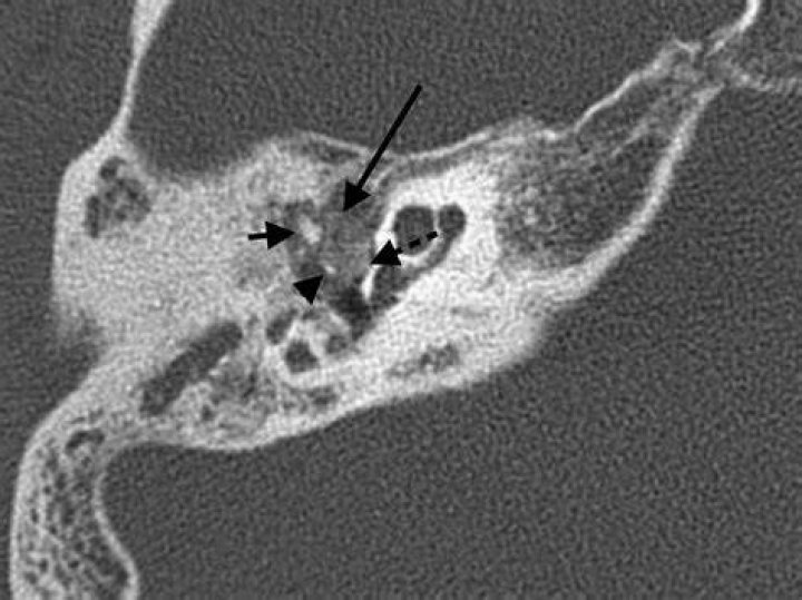 What does Tympanosclerosis look like?