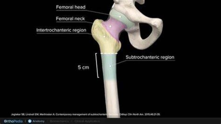 What is a subtrochanteric femur fracture?