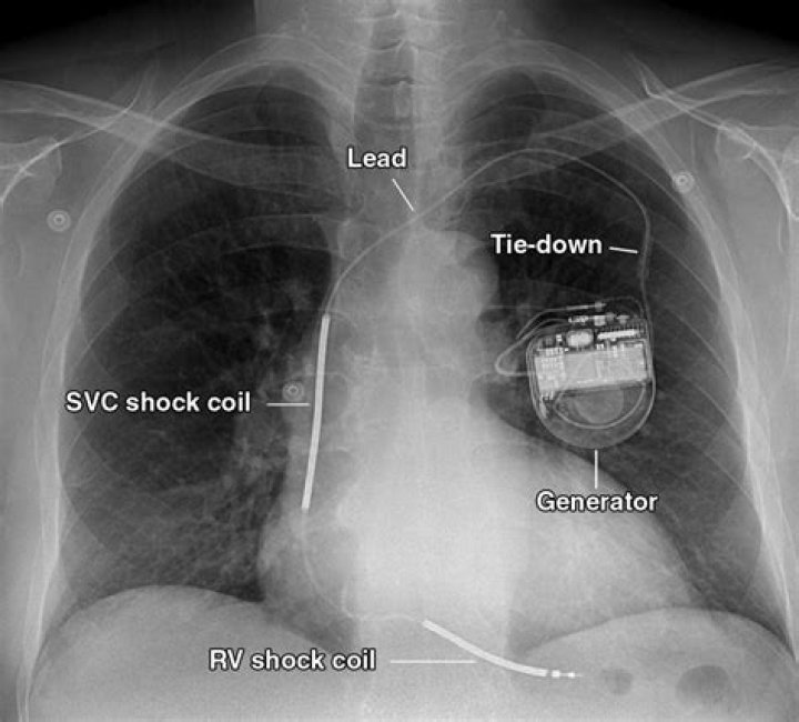 What is the life expectancy of a person with a pacemaker and defibrillator?