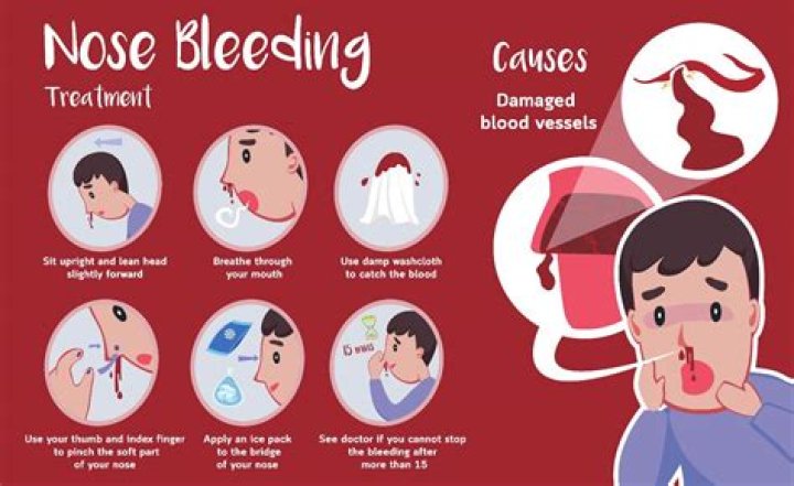 When should I be concerned about my childs nosebleed?