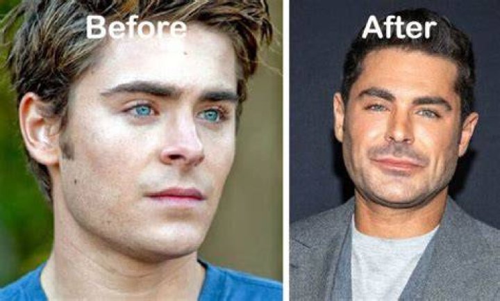 Zac Efron jaw injury explored as Baywatch star opens up on what caused
